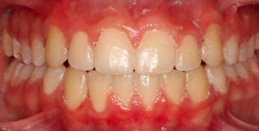 The same patient's teeth straightened after orthodontic treatment