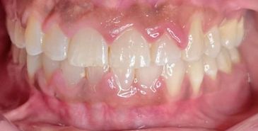 The same patient's teeth straightened after orthodontic treatment