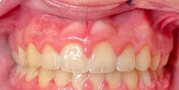 The same patient's teeth straightened after orthodontic treatment