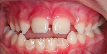 Close-up of a patient's crowded teeth before orthodontic treatment