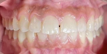 Close-up of a patient's crowded teeth before orthodontic treatment