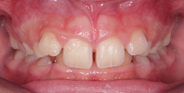 Close-up of a patient's crowded teeth before orthodontic treatment