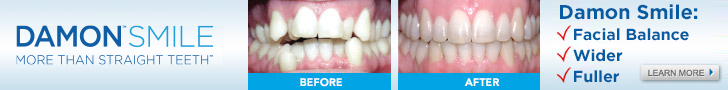 Before and after results with Damon Smile braces